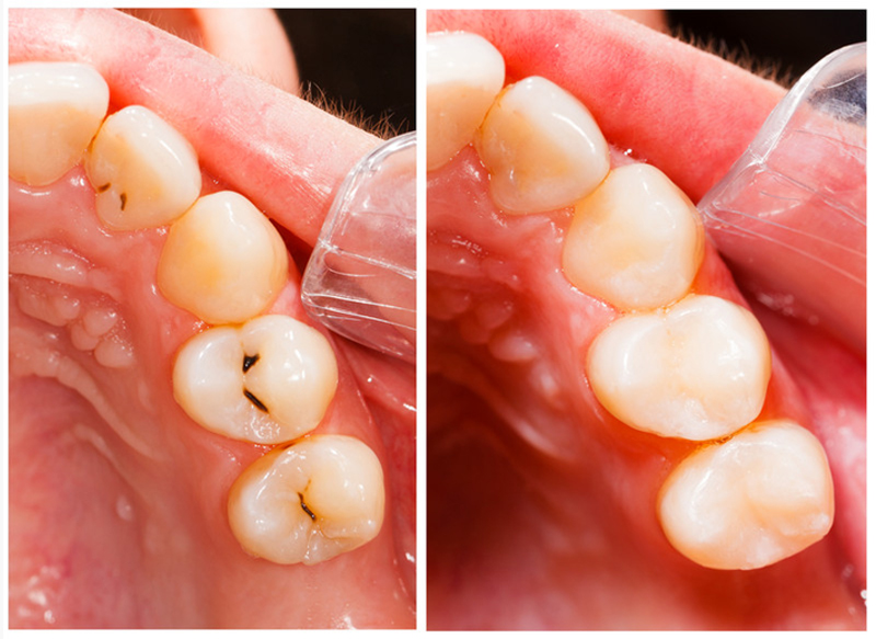 Fillings th Ave SE #
