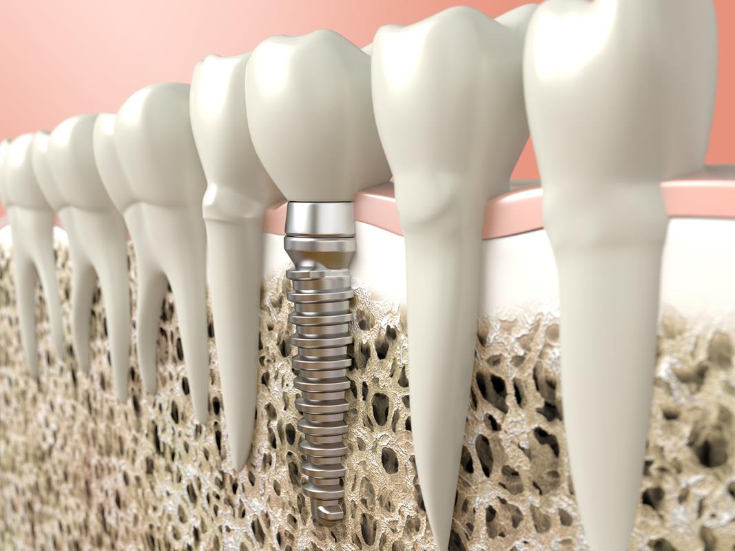 Dental Implants th Ave SE #