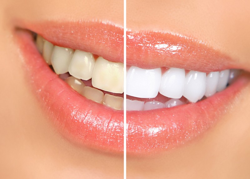 Teeth Whitening th Ave SE #