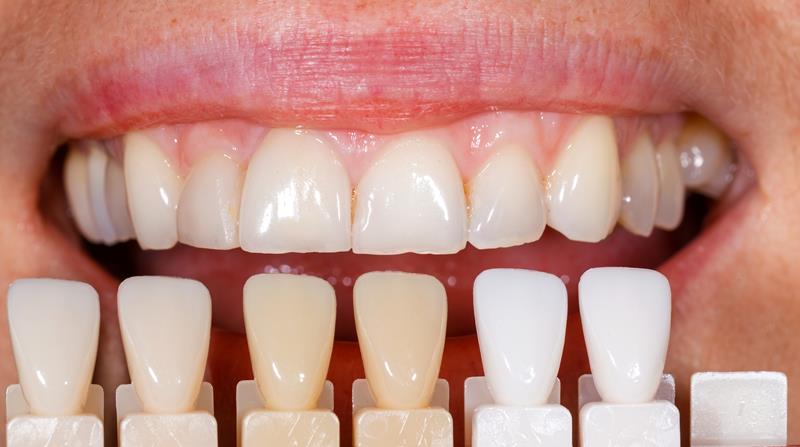 Veneers th Ave SE #