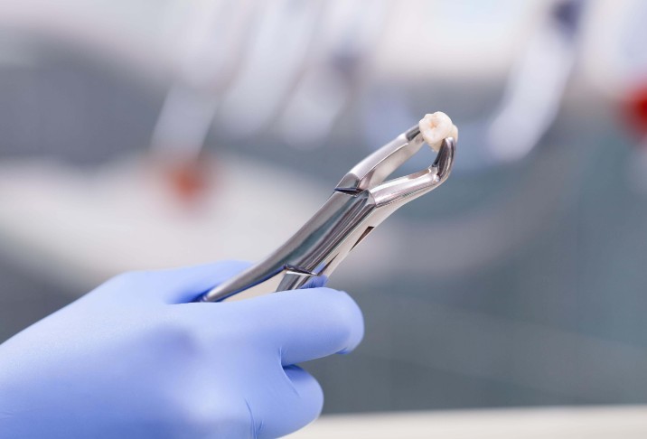 emergency tooth extraction mukilteo