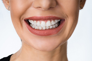 Woman wearing clear braces.